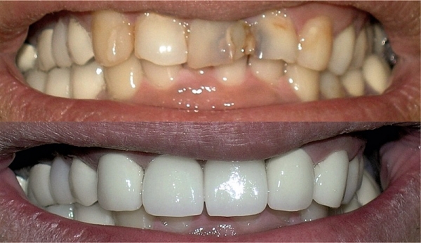 KOMPOZITNA RESTAURACIJA Potpuni makeover zuba brzo, bezbolno i povoljno